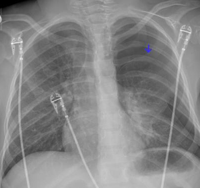 Asthma | Patient