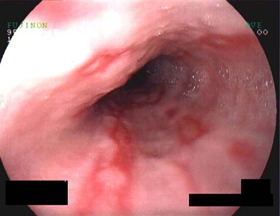 Gastro-oesophageal reflux disease (GORD) | Patient