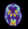 By US National Institute on Aging, Alzheimer's Disease Education and Referral Center [Public domain or Public domain], via Wikimedia Commons