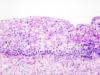 This is a file from the Wikimedia Commons.http://en.wikipedia.org/wiki/Cervical_intraepithelial_neoplasia 