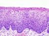 This is a file from the Wikimedia Commons.http://en.wikipedia.org/wiki/Cervical_intraepithelial_neoplasia 