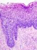 This is a file from the Wikimedia Commons.http://en.wikipedia.org/wiki/Cervical_intraepithelial_neoplasia 
