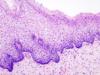 This is a file from the Wikimedia Commons.http://en.wikipedia.org/wiki/Cervical_intraepithelial_neoplasia 